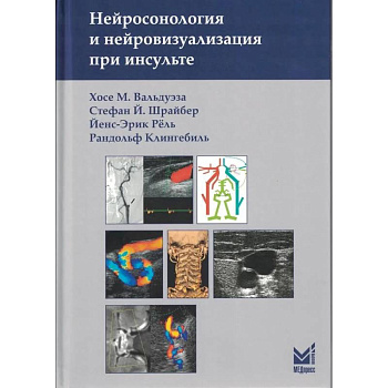 Нейросонология и нейровизуализация при инсульте